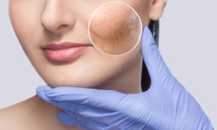 Descubra cómo curar las cicatrices del acné