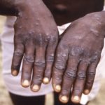 OMS insta a abordar con urgencia la propagación de la viruela símica en África