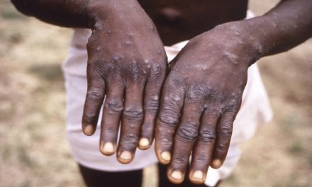 OMS insta a abordar con urgencia la propagación de la viruela símica en África