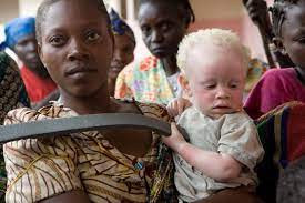 ¿Qué datos debes conocer sobre el albinismo?