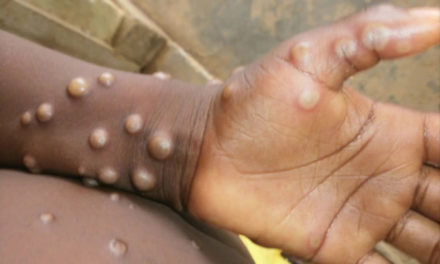 Más de 57 mil infectados de viruela símica se registran en el mundo